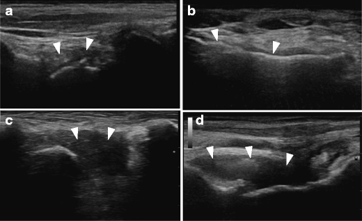 Point-of-care Ultrasonography in Orthopedic Management of Hemophilia ...