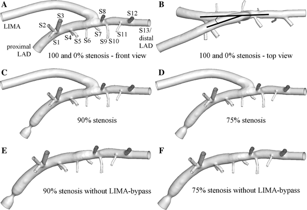 effect of the degree of lad stenosis on competitive flow and flow