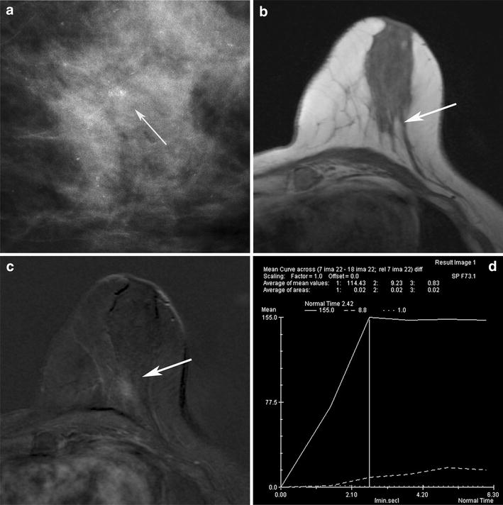 bi rads category 3 probably benign finding bi rads category 3 probably benign finding