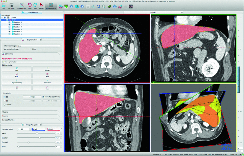 The Medical Imaging Interaction Toolkit challenges and advances