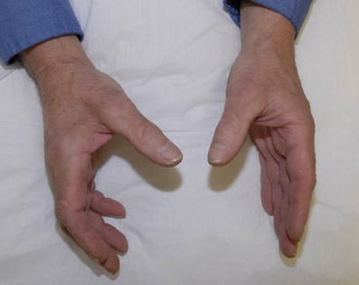 styloid thumb removal Cyst ulner styloid thumb removal Cyst ulner