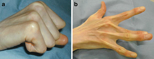 Locking of the metacarpophalangeal joint caused by idiopathic intrinsic ...