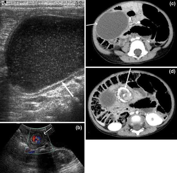 Mesenteric cysts associated with recurrent small-bowel volvulus: cause ...