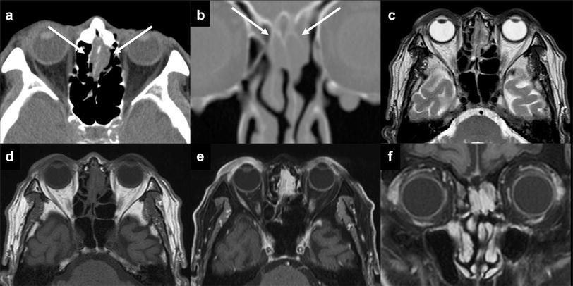 Imaging Features Of Benign Mass Lesions In The Nasal Cavity - 