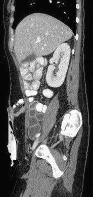 c diff colonoscopy findings c diff colonoscopy findings