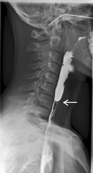 plummer vinson syndrome with proximal esophageal web plummer vinson syndrome