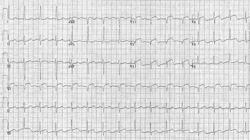 Wellens’ Syndrome in an Elderly Patient with Dementia | SpringerLink