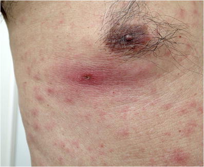 Scrub Typhus (Tsutsugamushi Disease) Presenting as Fever with an Eschar