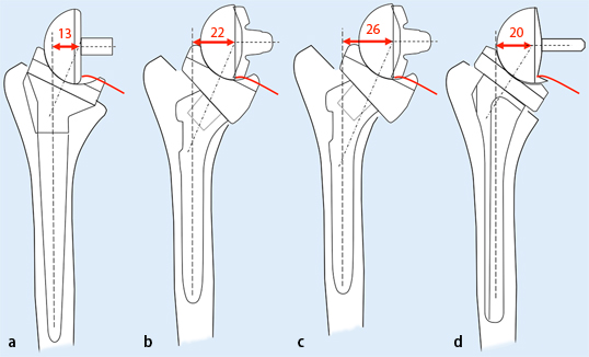 Prothese Inverser Design und Biomechanik inverser Schulterprothesen | SpringerLink