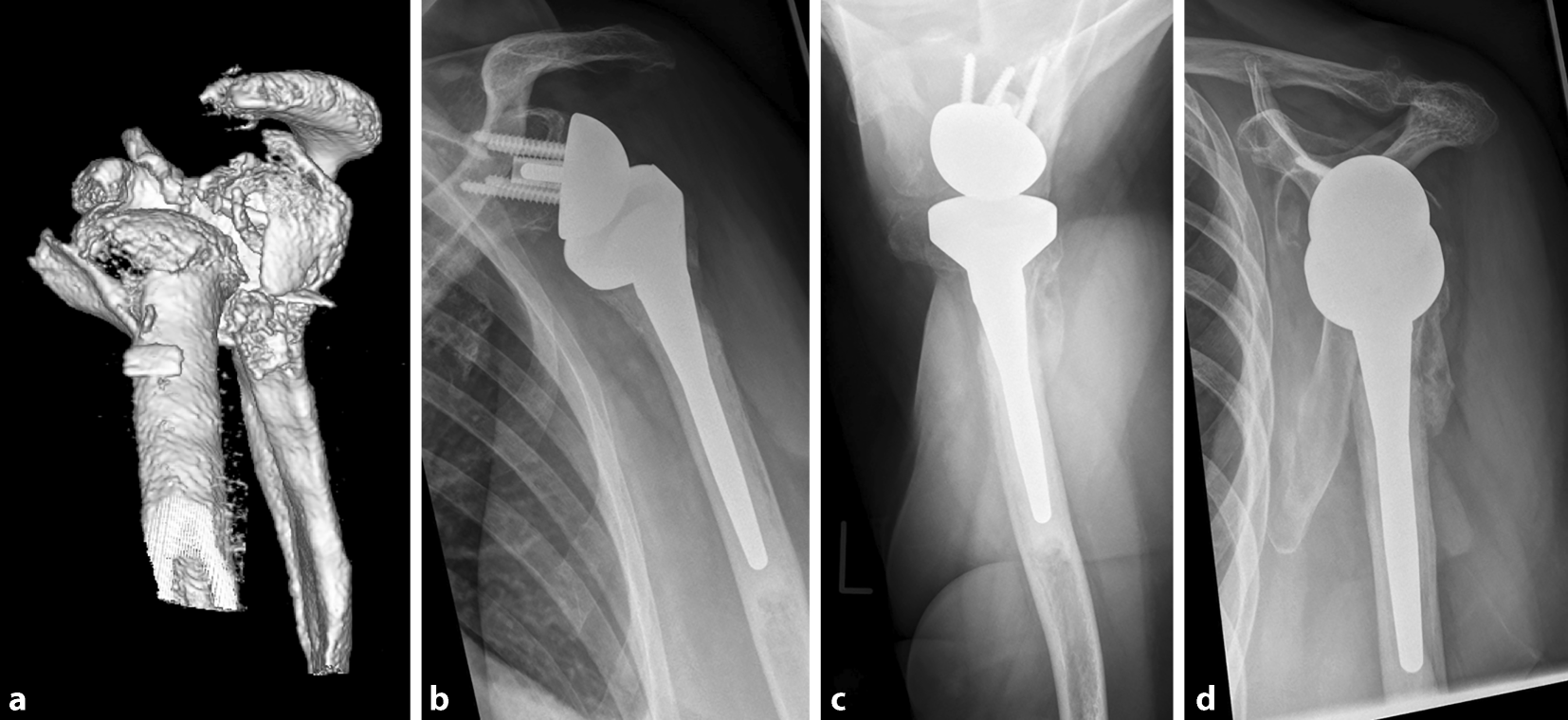 Headsplit fractures of the proximal humerus SpringerLink