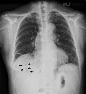 pneumobilia in chest radiograph springerlink pneumobilia