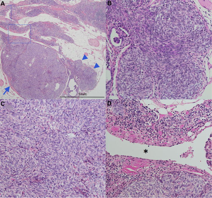 Microthymoma and microscopic thymomas associated with a thymic cyst