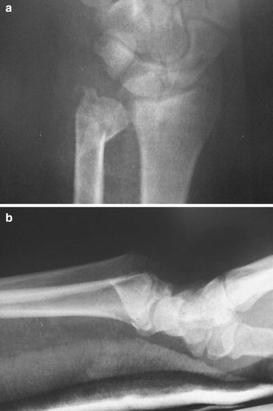Distal radius fracture management in elderly patients a literature review