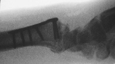 Distal radius fracture management in elderly patients a literature review