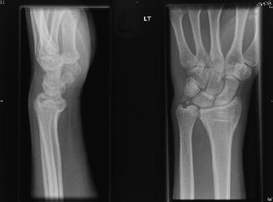Distal radius fracture management in elderly patients a literature review