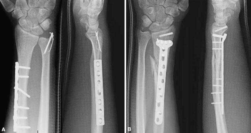 therapy galeazzi fracture