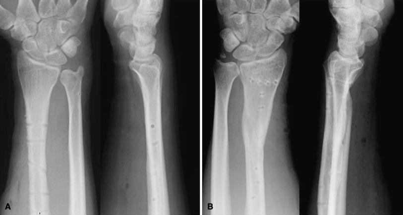 galeazzi fracture orthobullets