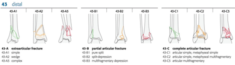 management of high energy tibial pilon fractures springerlink tibial plafond