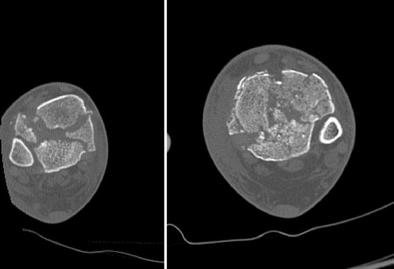 Management Of High Energy Tibial Pilon Fractures Springerlink