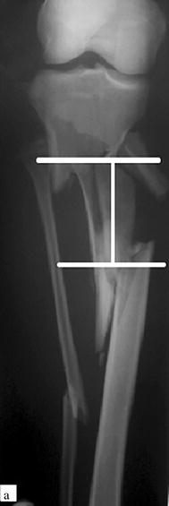 Bone transport for the management of severely comminuted fractures