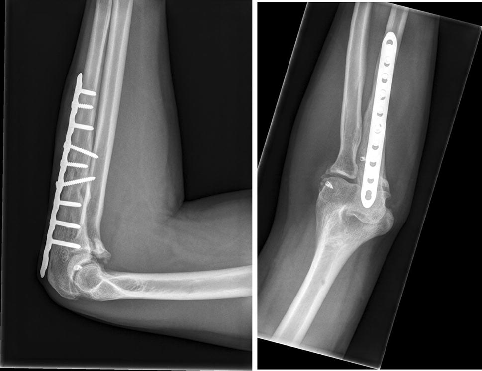 Unusual case of complex fracture dislocation of the elbow SpringerLink