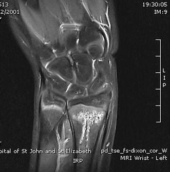 occult fracture occult fracture