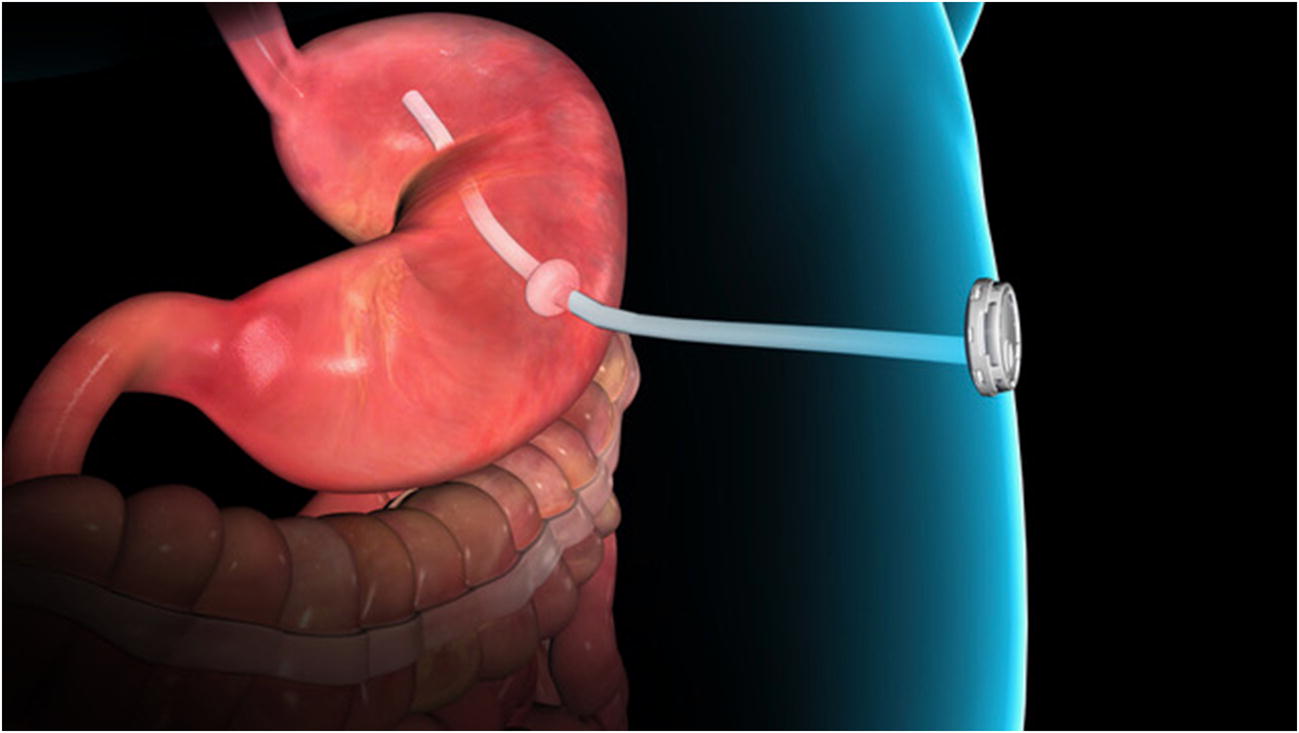 Medical Devices in Obesity Treatment SpringerLink