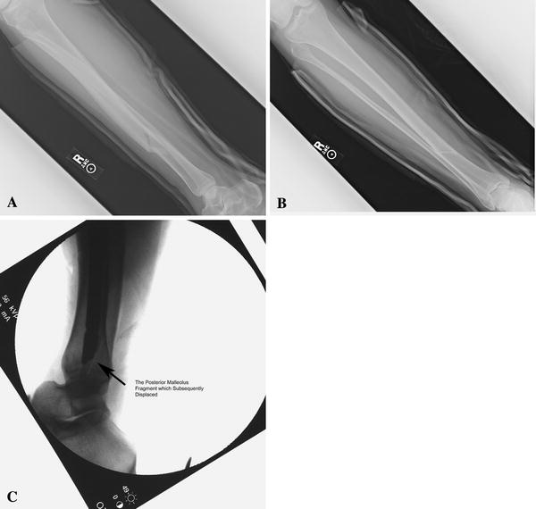 icd 10 lateral malleolus fracture icd 10 lateral malleolus fracture