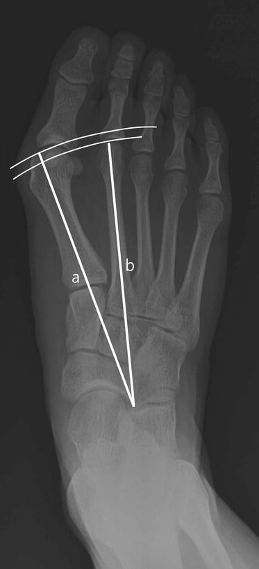 Reliability and Relationship of Radiographic Measurements in Hallux ...