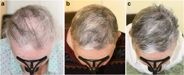 alopecia universalis vs alopecia areata alopecia universalis vs alopecia areata