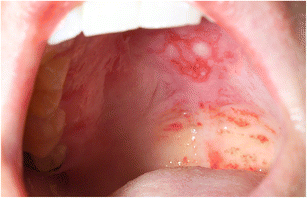 The Cutaneous Spectrum of Lupus Erythematosus | SpringerLink