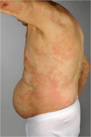 Autoimmune Subepidermal Bullous Diseases of the Skin and Mucosae ...