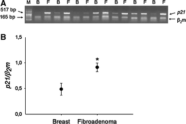 Gene and protein expression of p53 and p21 in fibroadenomas and ...
