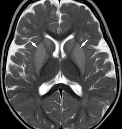 Neuroimaging Of Abusive Head Trauma Springerlink