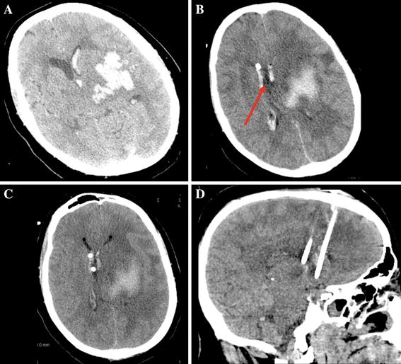 Strategic Placement of Bedside Ventriculostomies Using Ultrasound Image