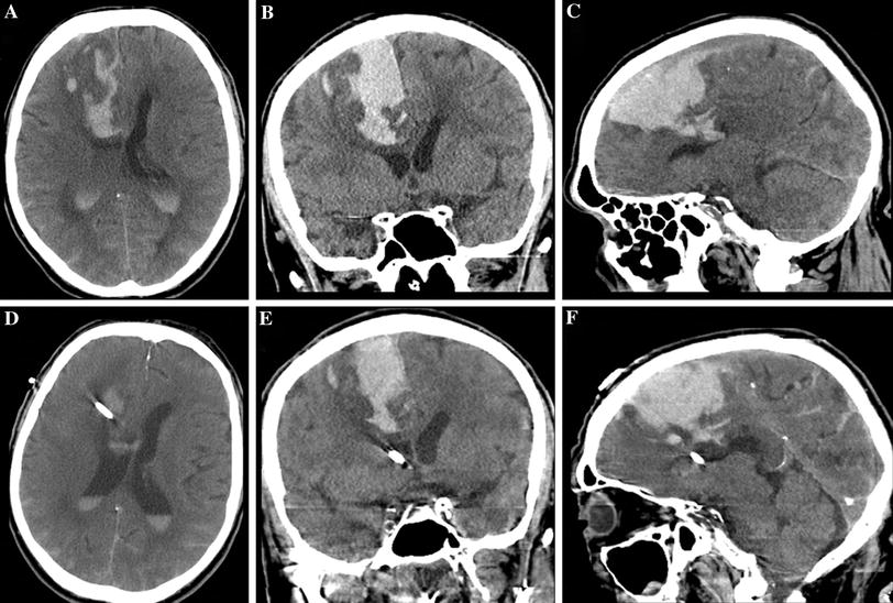 Strategic Placement of Bedside Ventriculostomies Using Ultrasound Image