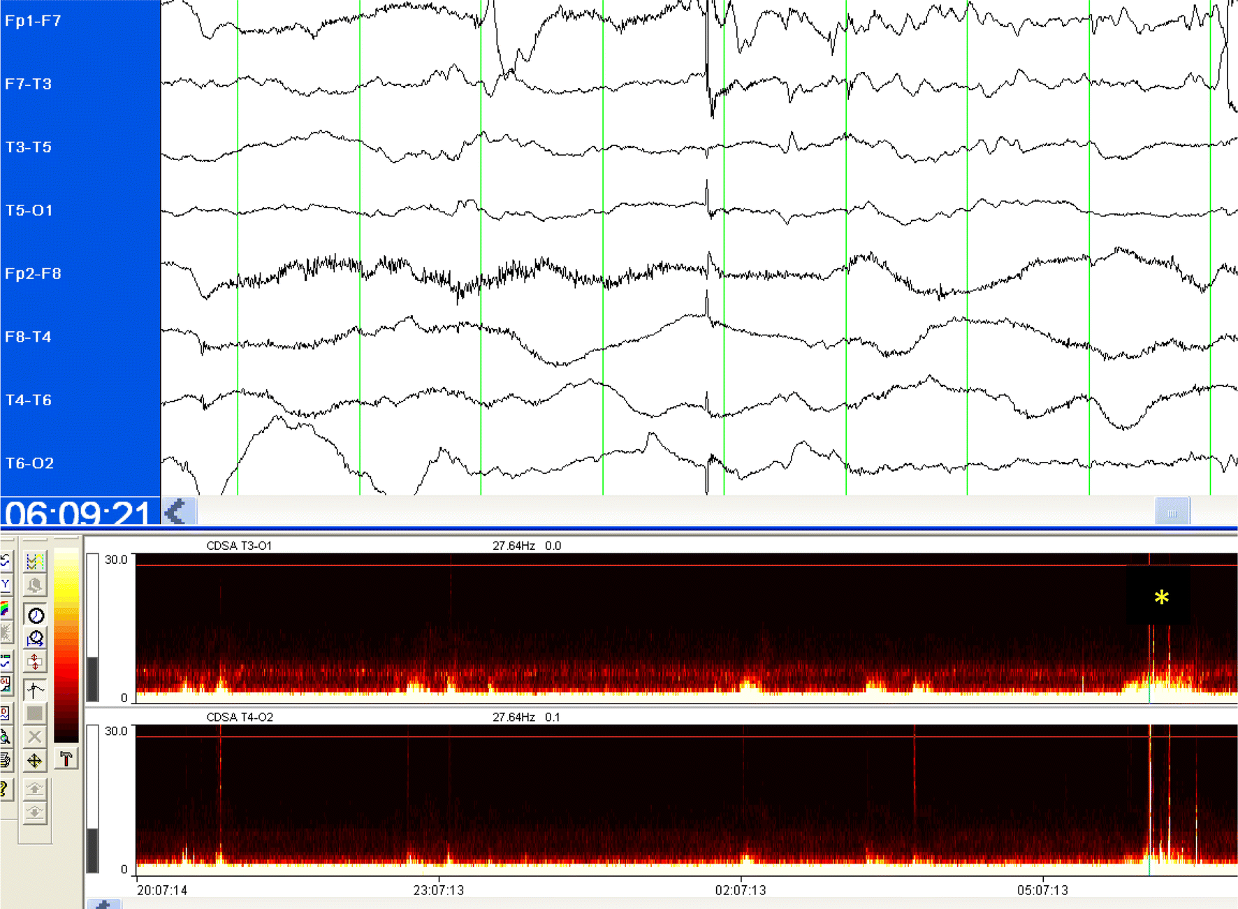 Quantitative Continuous EEG Bridging the Gap Between the ICU Bedside