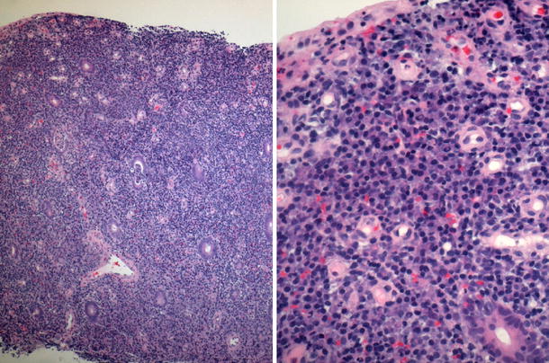 Extranodal Marginal Zone B Cell Mucosa Associated Lymphoid Tissue Malt Lymphoma Of Cecum