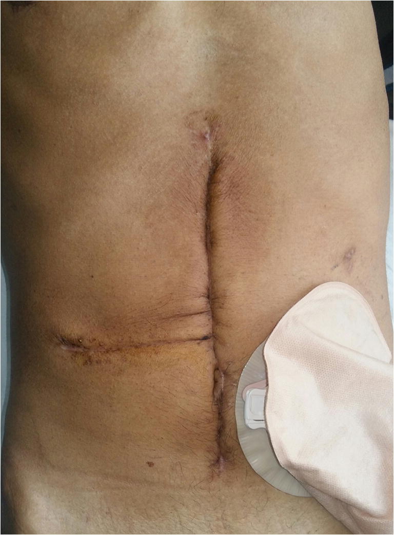 Pancreatic Malignant Gastrointestinal Stromal Tumor A Case Report
