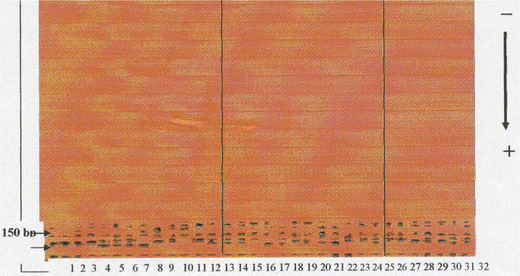 role of microsatellites instability in carcinogenesis of plummer vinson syndrome