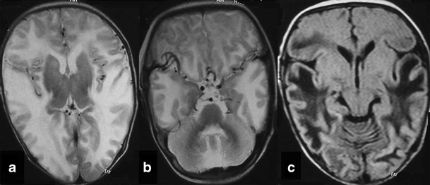 Macrocephaly With Diffuse White Matter Changes Simulating A