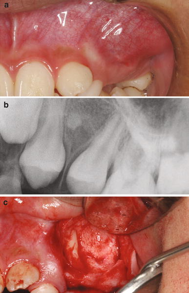 peripheral calcifying odontogenic cyst a case report and review of odontogenic cyst