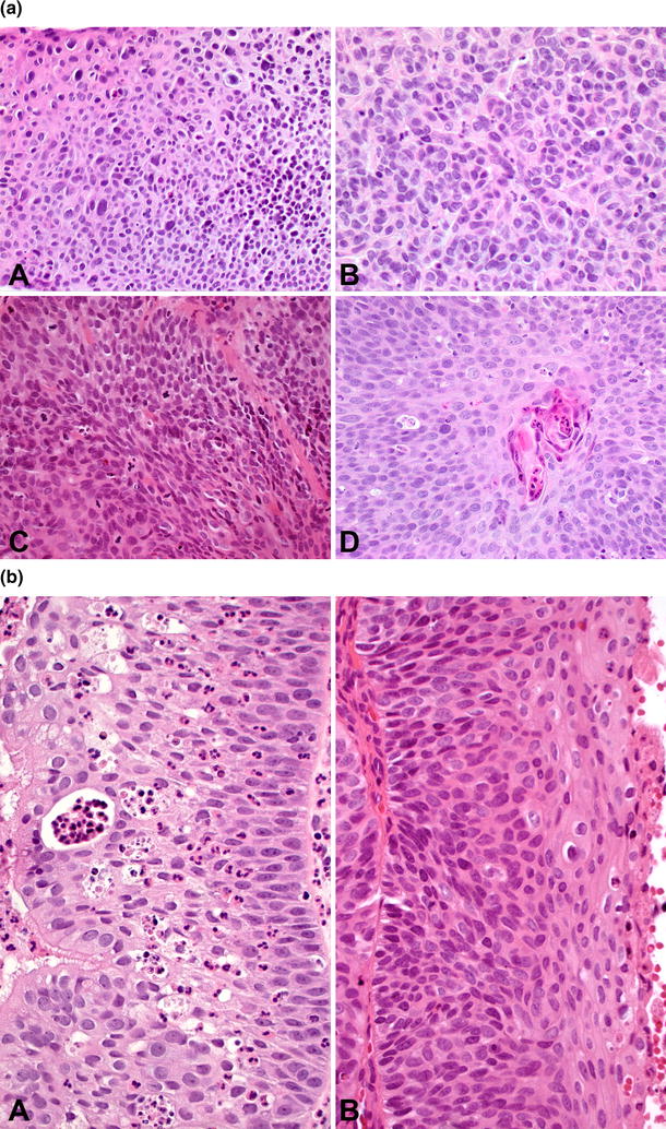 Carcinoma Ex-Schneiderian Papilloma (Malignant Transformation): A ...