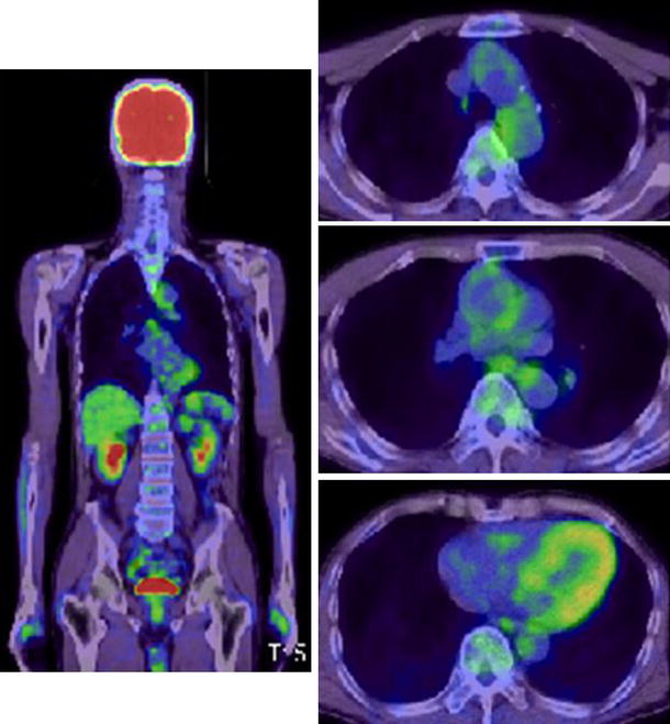 Intravascular large B-cell lymphoma with diffuse FDG uptake in the lung ...