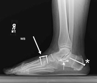 acquired flatfoot deformity approach treatment adult fig
