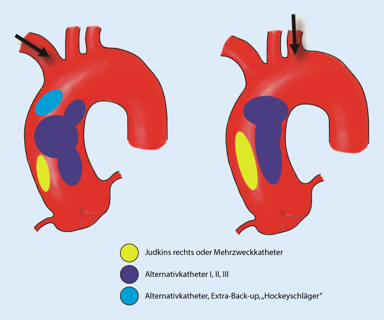 Arteria Radialis Verschluss Nach Herzkatheter