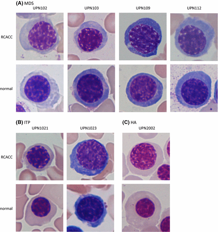 Proposal of criteria for dyserythropoiesis in the diagnosis of myelodysplastic syndromes
