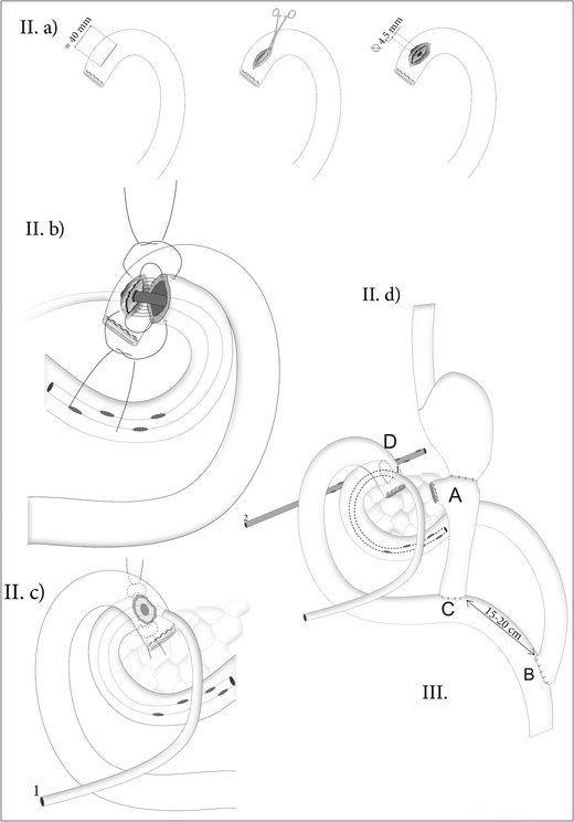 An Effective Surgical Treatment For Repeatedly Leaking Duodenal Stumps 