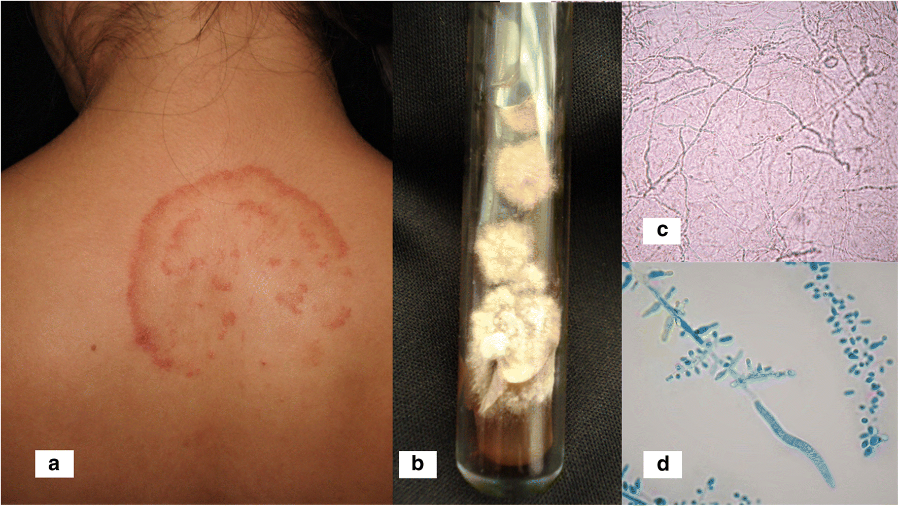 Tinea Gladiatorum An Update Springerlink