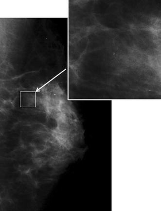 sentinel node biopsy side effects sentinel node biopsy side effects